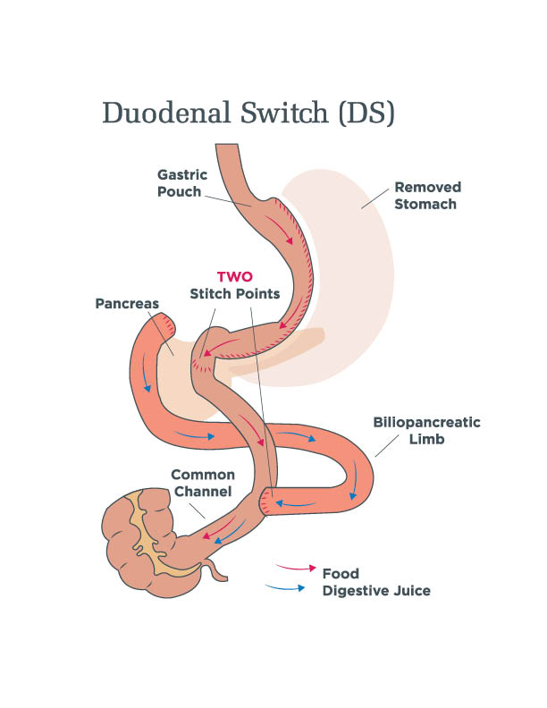 Post-Operative Diet Stages for Duodenal Switch (BPD/DS)