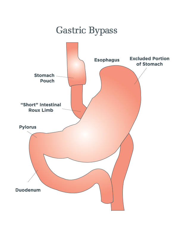 Size of the Stomach After Gastric Sleeve Surgery