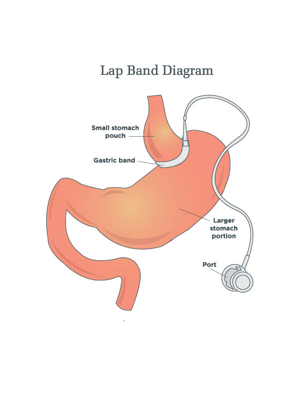 Gastric Band Surgery (LAP-Band): What It Is, Requirements, 56% OFF