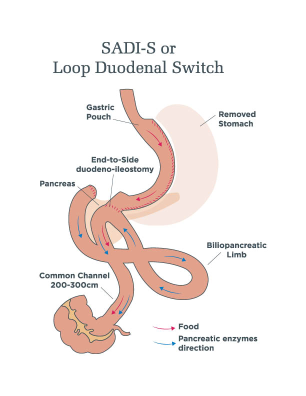 duodenal-switch-procedures-sadi-s-and-classic-ds-ut-health-tyler