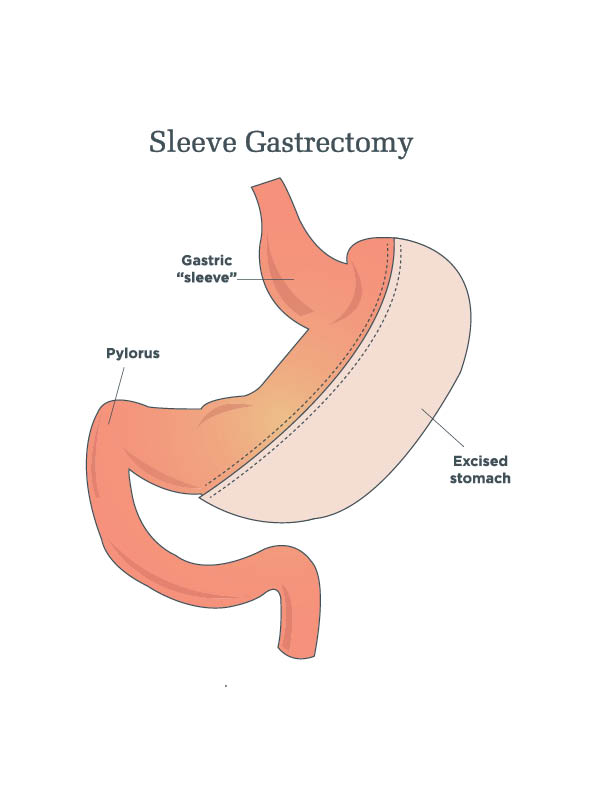 Sleeve gastrectomie